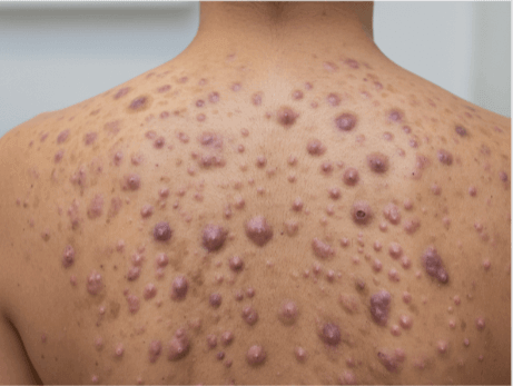 אקנה דלקתי בגב